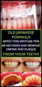 OLD JAPANESE FORMULA APPLY THIS MIXTURE FOR 60 SECONDS AND REMOVE TARTAR AND PLAQUE FROM YOUR TEETH!