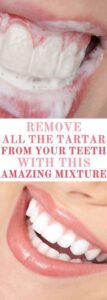 TRY THIS AMAZING MIXTURE AND REMOVE ALL THE TARTAR FROM YOUR TEETH!