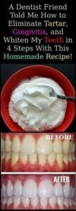 A Dentist Friend Told Me How To Eliminate Tartar, Gingivitis and Whiten My Teeth In 4 Steps With This Homemade Recipe