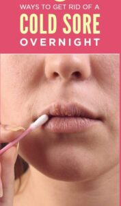How To Get Rid Of A Cold Sore Overnight Without Medicine