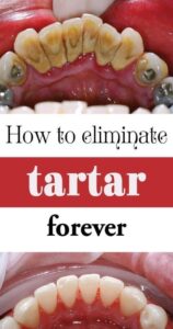 BE YOUR OWN DENTIST! HERE ARE TRICKS TO REMOVE TARTAR BUILDUP AT HOME