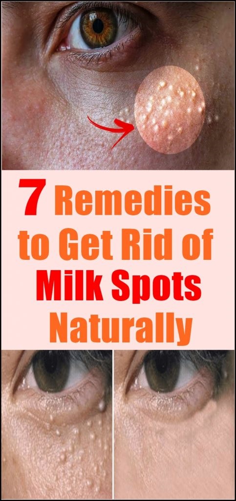 how to get rid of milk spots on face naturally