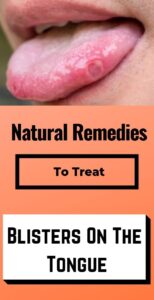Natural Remedies To Treat Blisters On The Tongue At Home